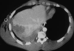 Liver Injury and Lung Parenchymal Injury - CTisus CT Scan