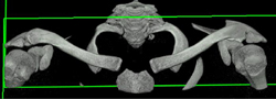 Normal Acromioclavicular and Sternoclavicular Joints - CTisus CT Scan