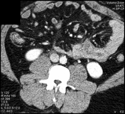Mesenteric Hematoma - CTisus CT Scan
