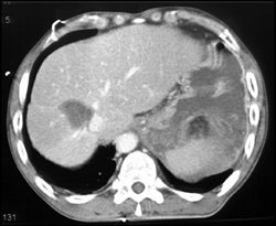 Left Diaphragm Tear - CTisus CT Scan