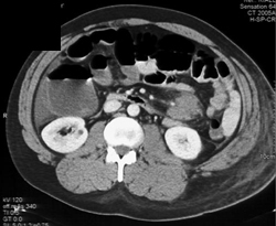 Intra-abdominal Bleed With Mesenteric Hematoma - CTisus CT Scan