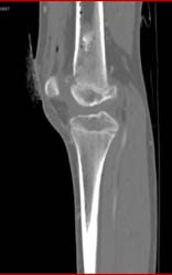 GSW to Knee With Bleed and Hematoma But No Vascular Injury - CTisus CT Scan