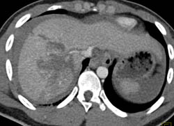 Liver and Renal Laceration With Hemoperitoneum - CTisus CT Scan
