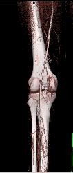 GSW Knee With Vascular Injury - CTisus CT Scan