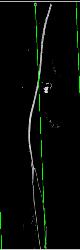 GSW Knee With Vascular Injury - CTisus CT Scan