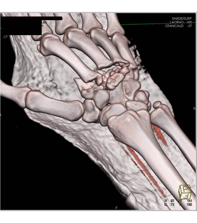 3D Mapping of Multiple Metacarpal Fractures with Excellent Visualizations of Tendons - CTisus CT Scan