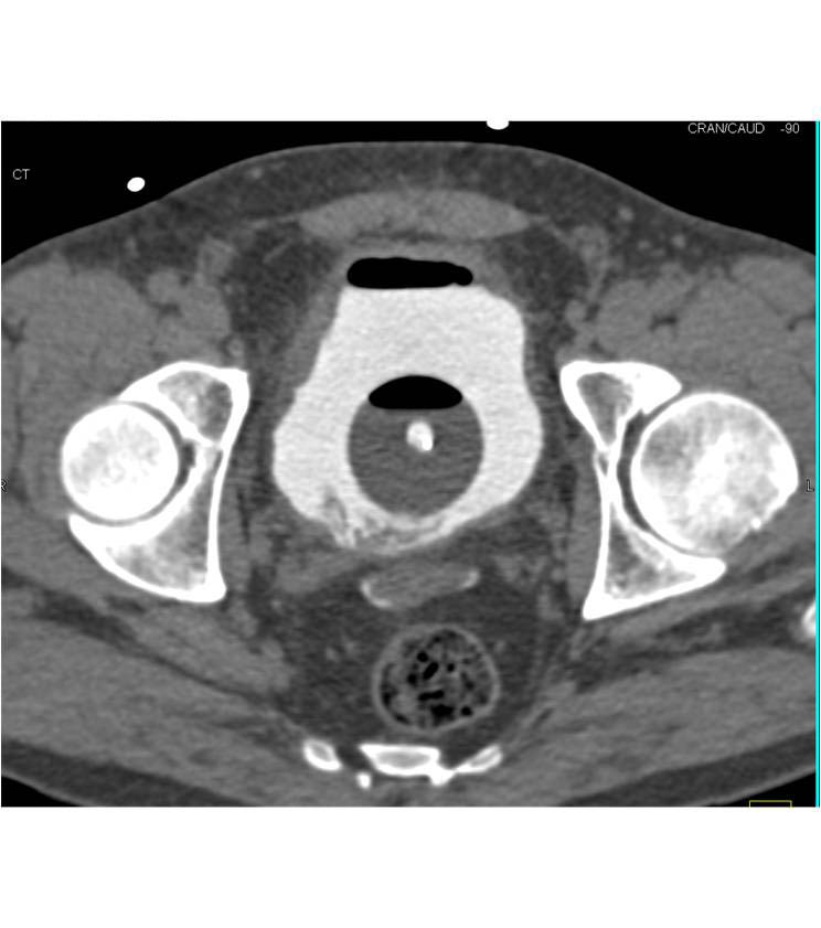 CT Cystogram with Bladder Perforation and Intraperitoneal Bladder Rupture - CTisus CT Scan