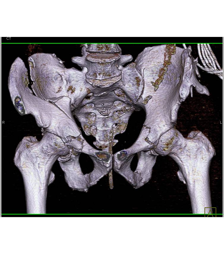 Iliac Wing Fracture Extend Into The Acetabulum - CTisus CT Scan