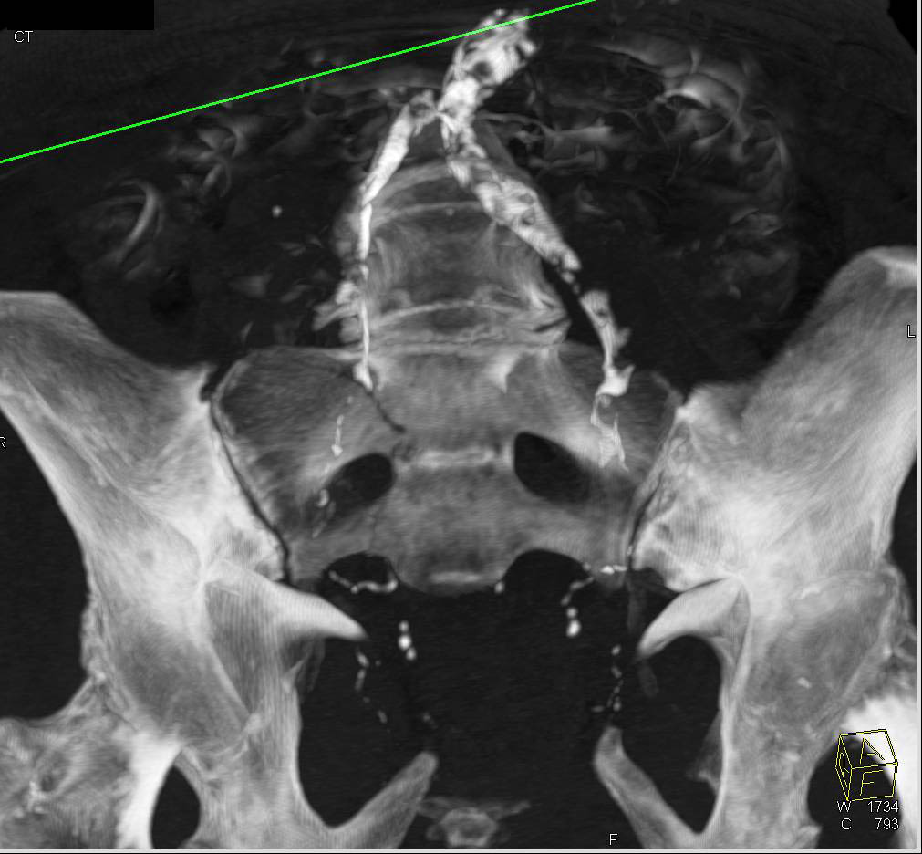 Sacral Fracture - CTisus CT Scan