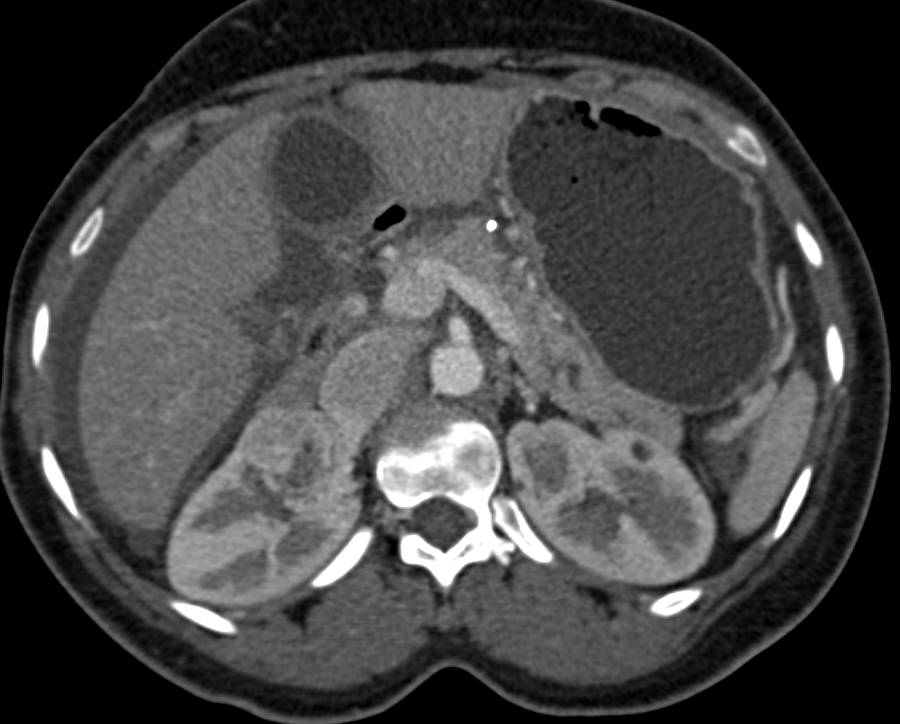 Free Fluid in Abdomen s/p Trauma - CTisus CT Scan