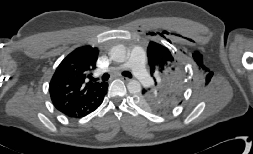 Gunshot Wound with Scapular and Rib Fractures as well as Pulmonary Contusion and Hemothorax - CTisus CT Scan