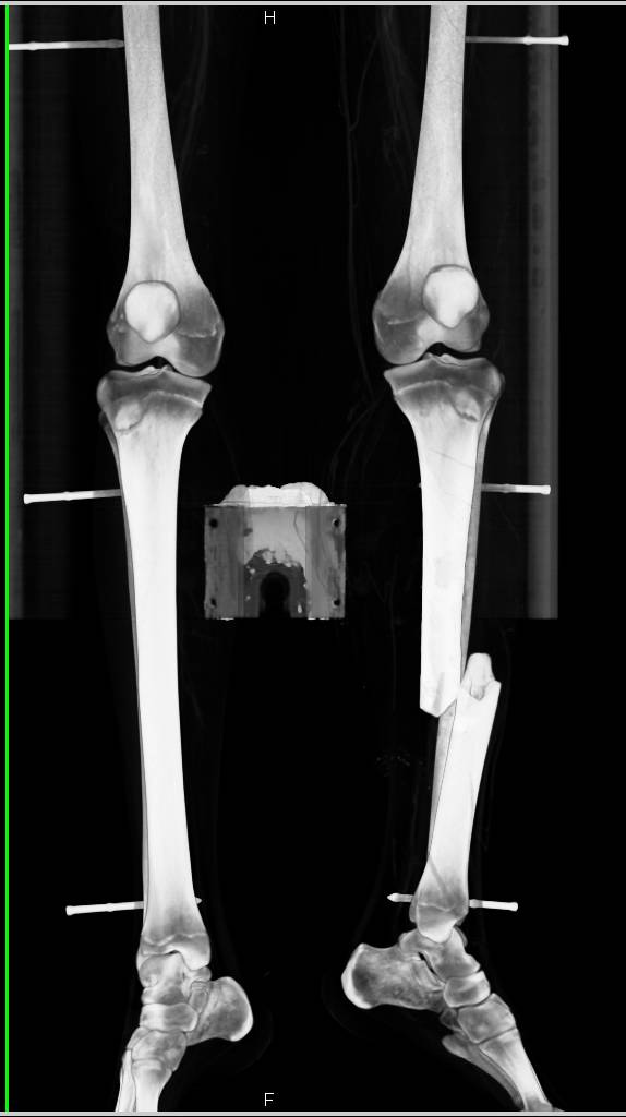 Open Wound with Tibial and Fibular Fracture and Vascular Injury - CTisus CT Scan