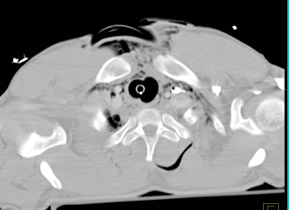 Pneumomediastinum due to Trauma - CTisus CT Scan