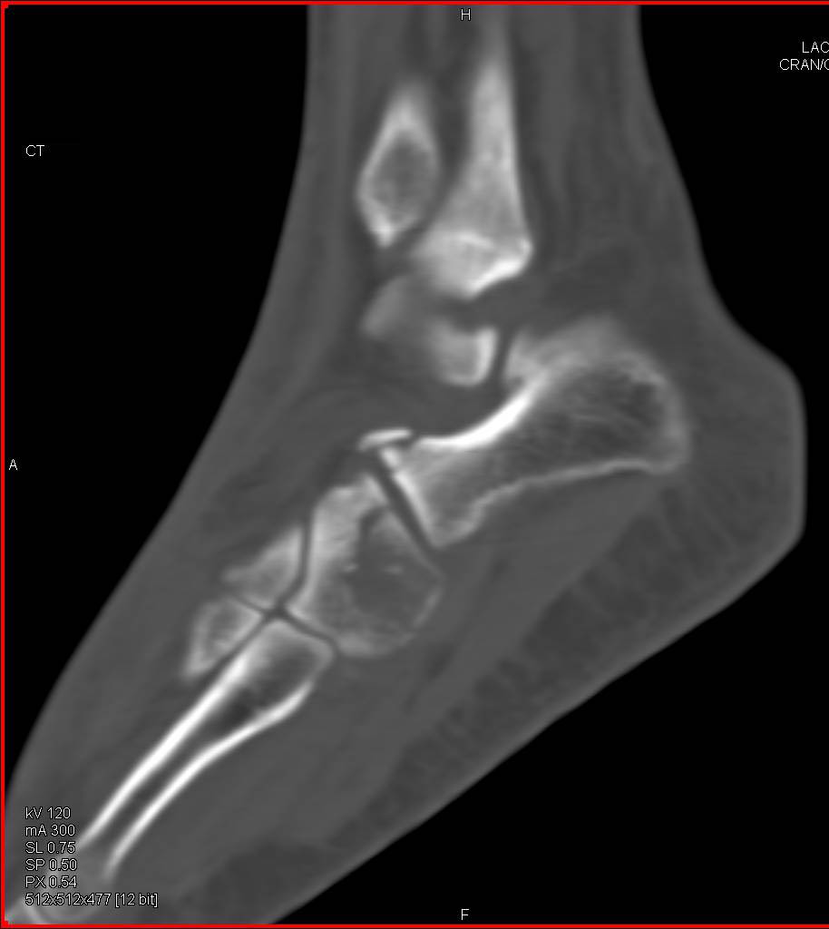 Calcaneus and Cuboid fractures - CTisus CT Scan