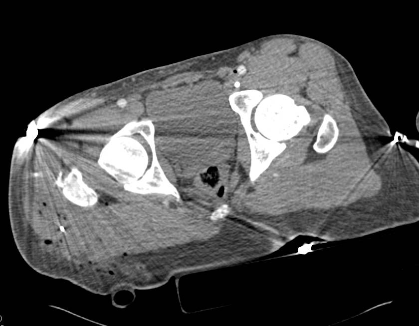 Gun Shot Wound Right Thigh with Active Bleed and Femur Fracture - CTisus CT Scan