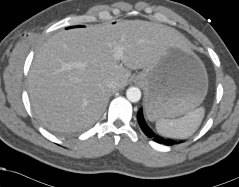 Gunshot to Right Upper Quadrant with Renal laceration and Injury to the Hepatic Flexure. Set of Scans with Rectal Contrast Shows Contrast Extravasation. - CTisus CT Scan