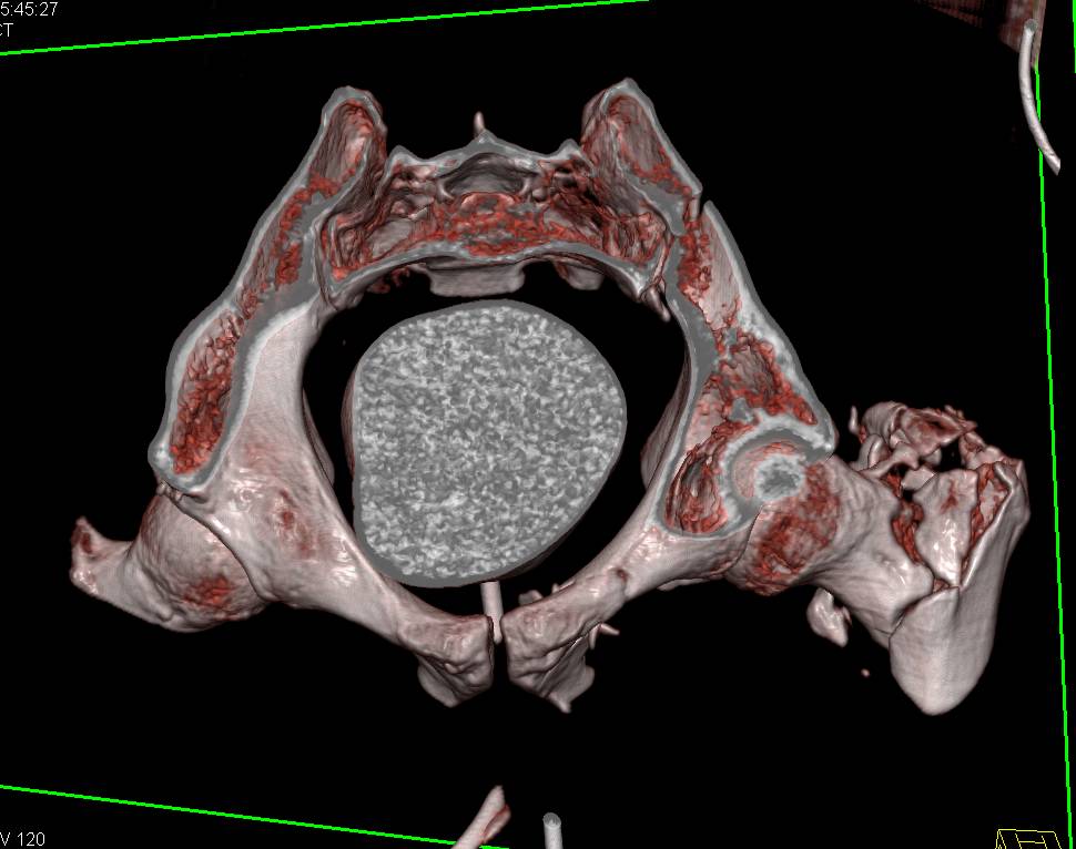 Comminuted Pelvic Fractures without Bladder Injury - CTisus CT Scan