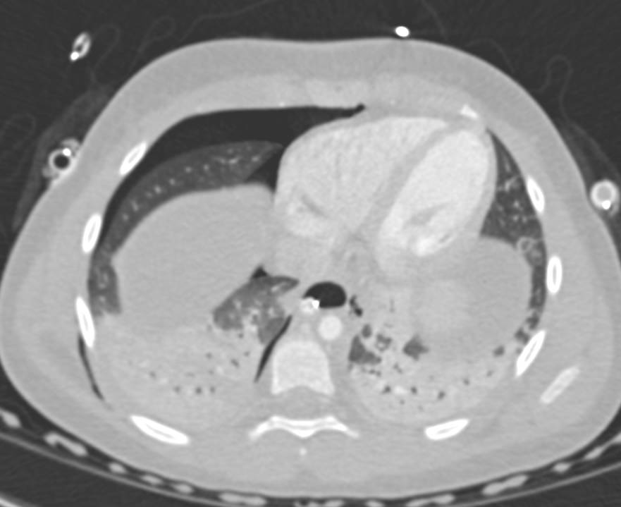 MVA with Pulmonary Contusion and Pneumothorax as well as Hemoperitoneum with Densely Enhancing Adrenals Glands due to Hypotension - CTisus CT Scan