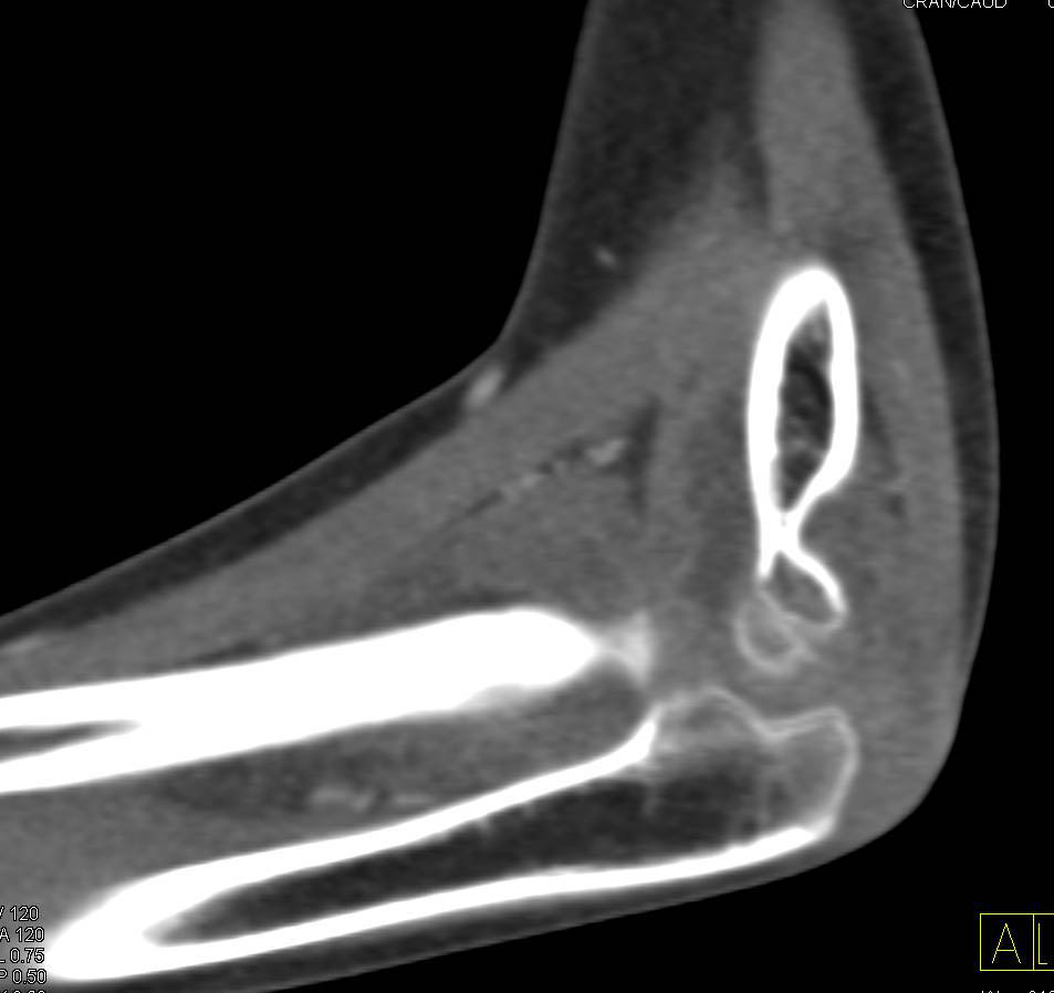 Positive Fat Pad Sign With Trauma to Elbow - CTisus CT Scan