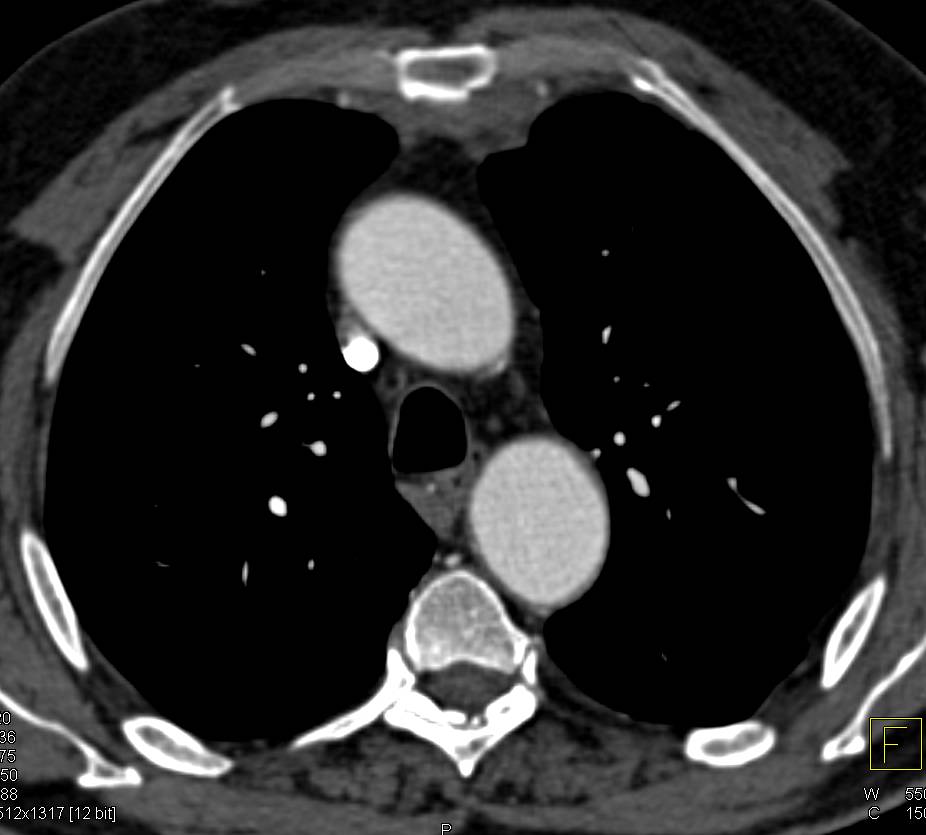 Sternal Fracture with Retrosternal Hematoma - CTisus CT Scan