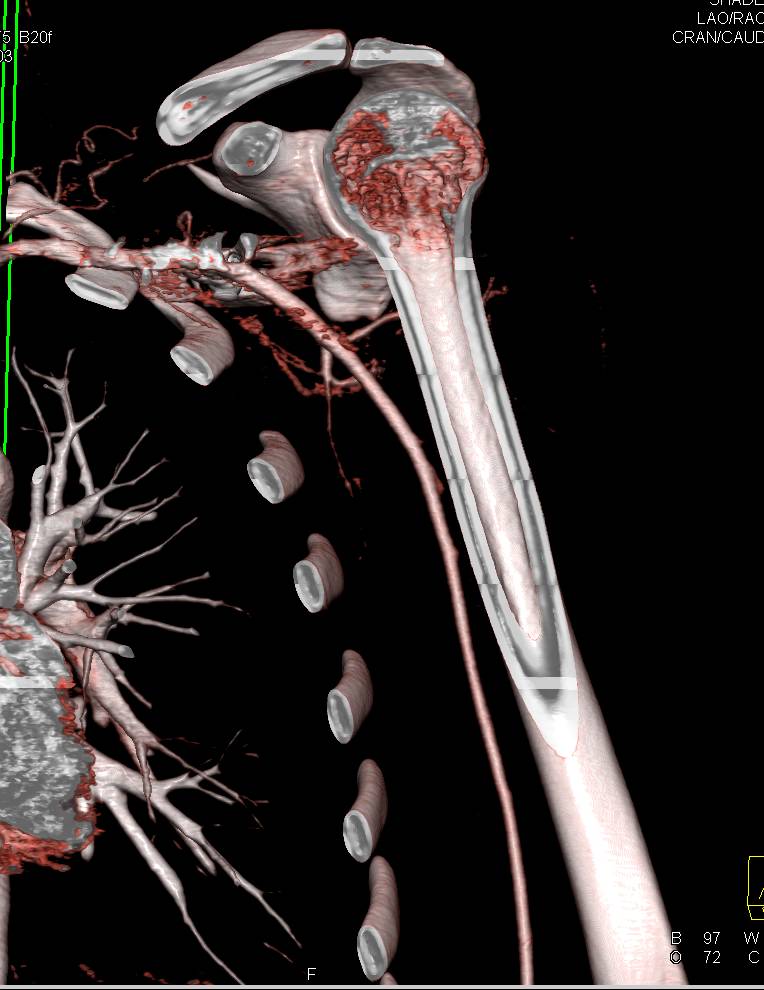 CTA Shoulder Without Injury Post Trauma - CTisus CT Scan