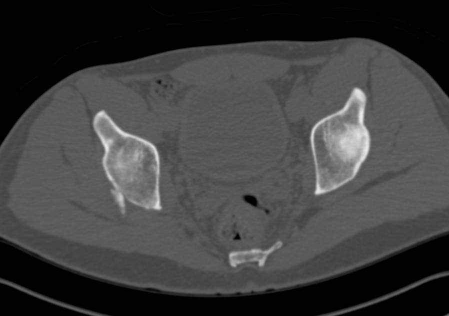 Right Acetabular Fracture Involves Posterior Column of the Acetabulum - CTisus CT Scan