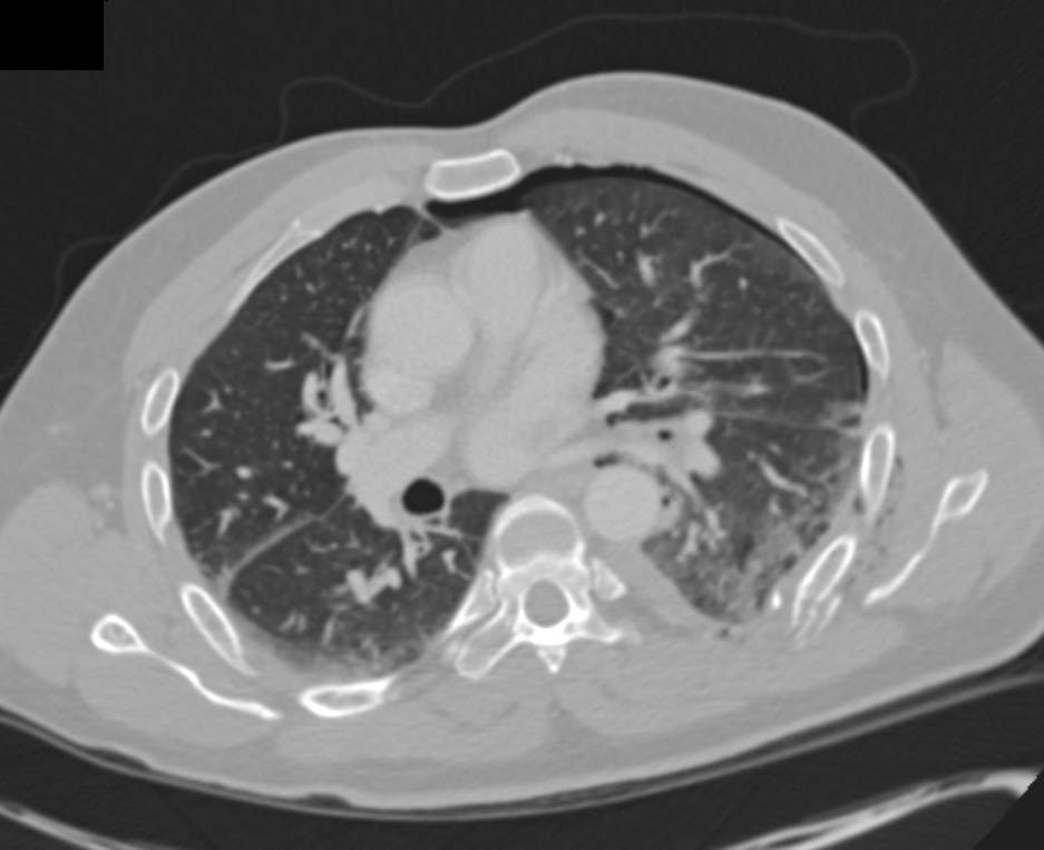 Trauma with Rib Fractures and Pneumothorax - CTisus CT Scan