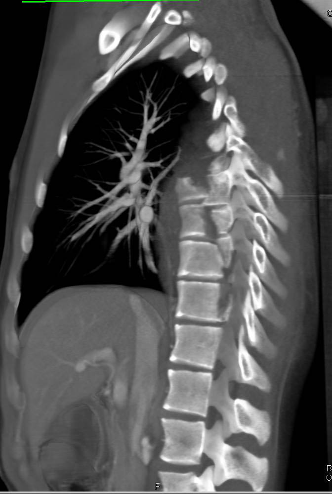 Complex Thoracic Spine Fractures with Paraspinal Hematoma - CTisus CT Scan