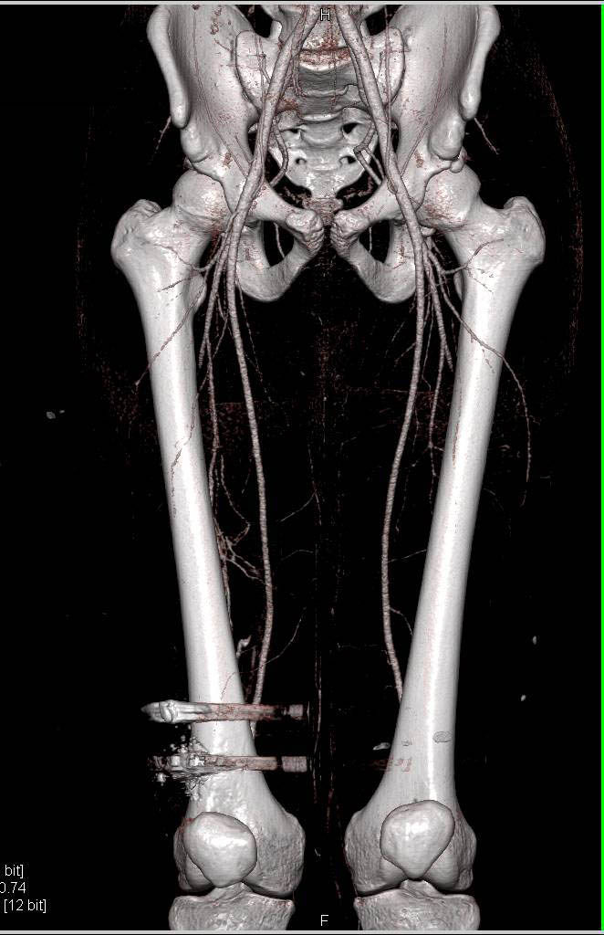 CTA Runoff s/p Gunshot Without Vascular Injury - CTisus CT Scan