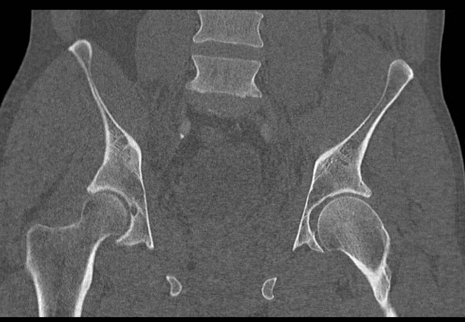 Iliac and Sacral Fractures - CTisus CT Scan