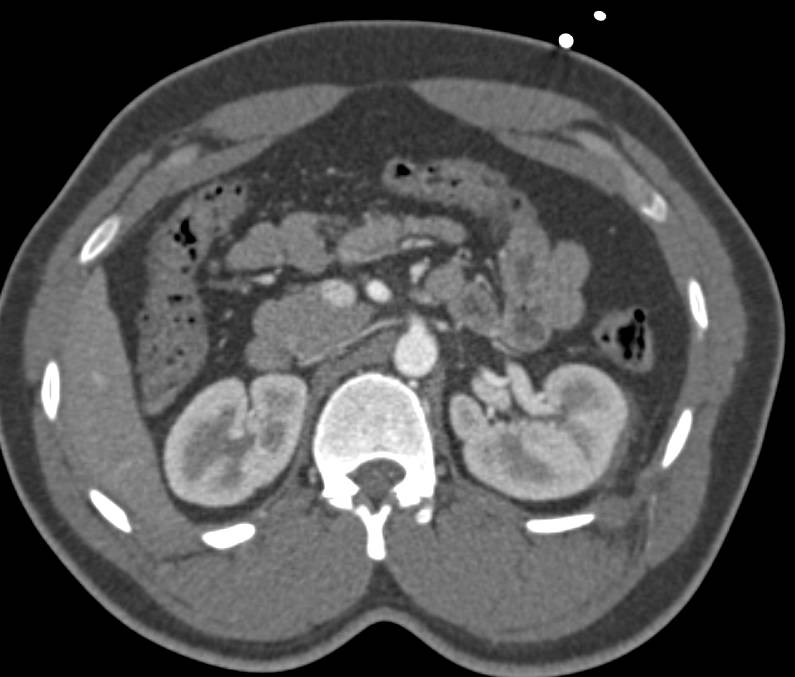 GSW with Renal Laceration but No Colon Injury (rectal contrast) - CTisus CT Scan