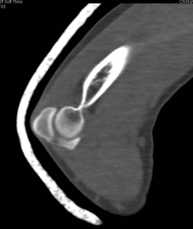 Positive fat Pad Sign Following Trauma to Elbow - CTisus CT Scan