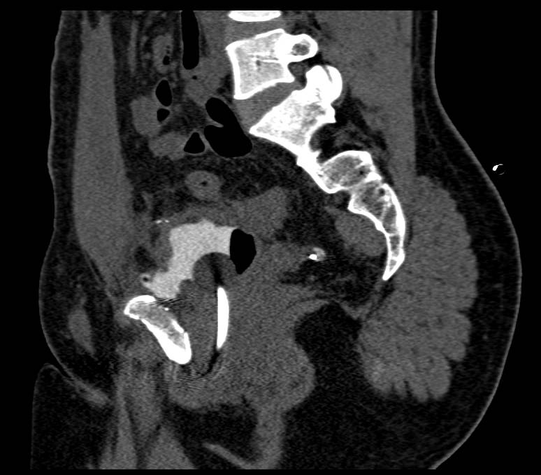 Symphysis Fracture with Associated Bladder Injury - CTisus CT Scan