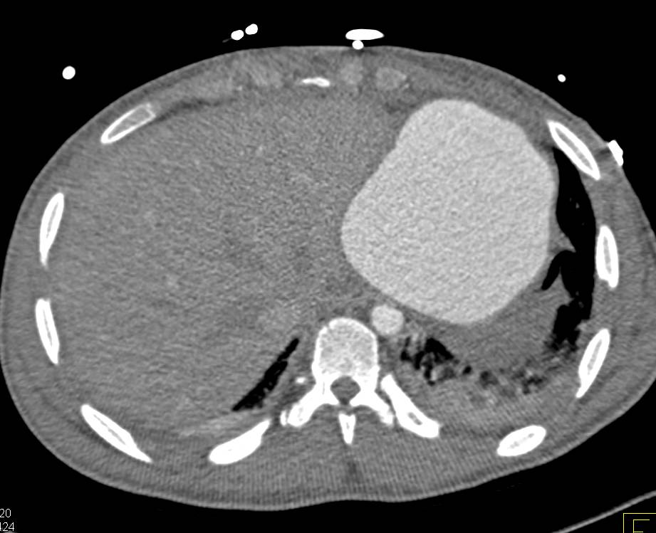 Left Ventricular Aneurysm from Stab Wound - CTisus CT Scan