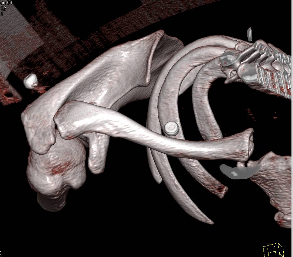 Dislocated Sternoclavicular Joint - CTisus CT Scan