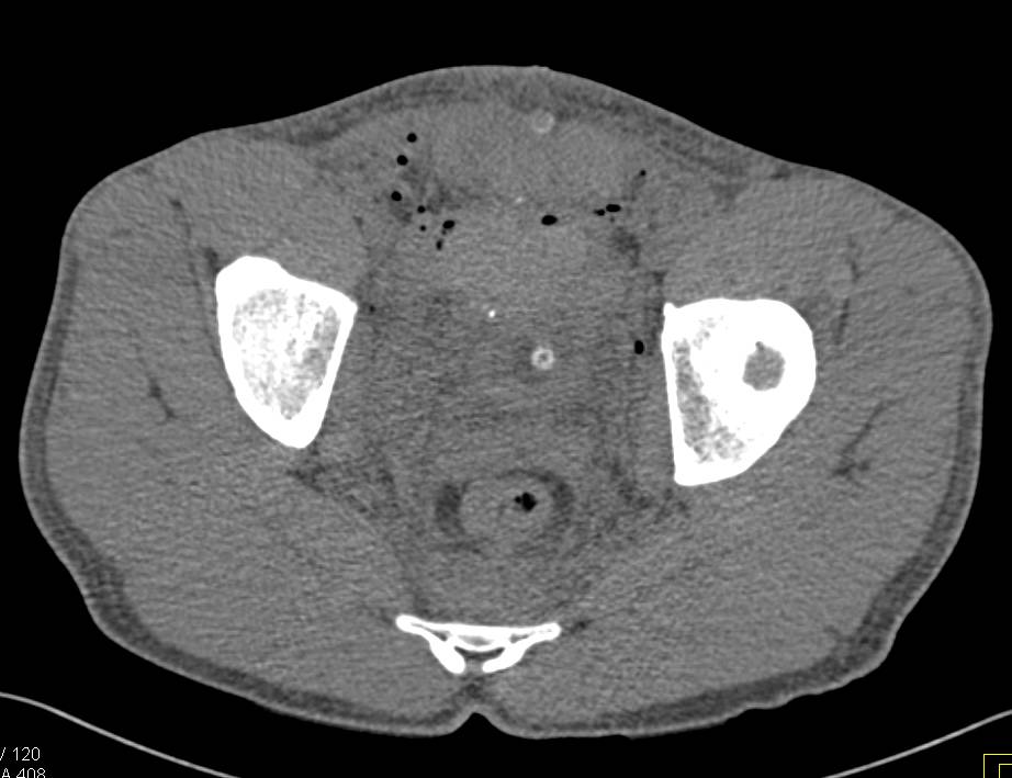 GSW with Superior Pubic Ramus Fracture and Bladder Injury - CTisus CT Scan