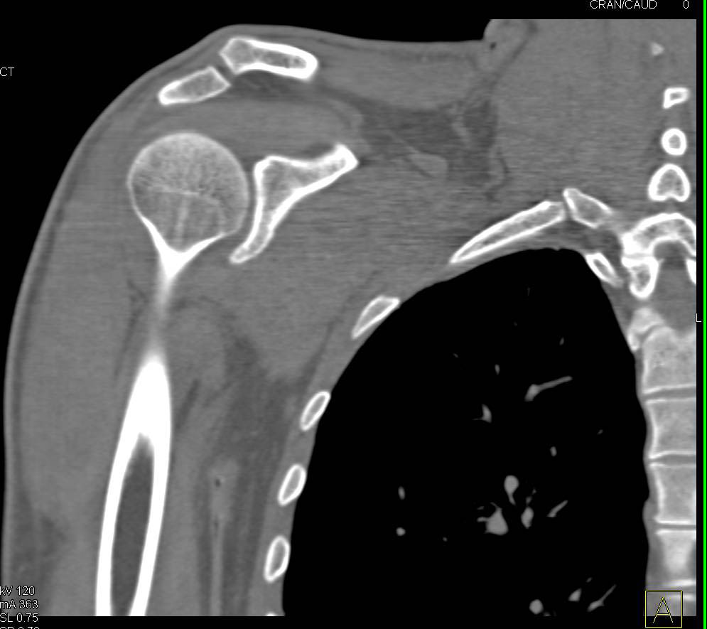 Comminuted Scapular Fracture - CTisus CT Scan