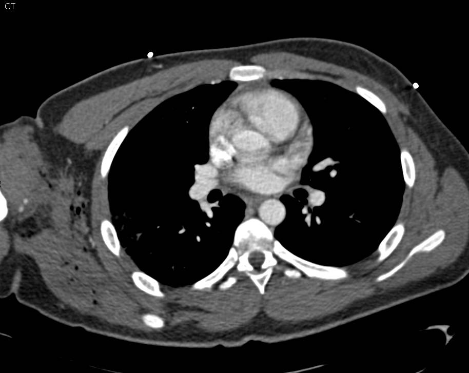 Trauma Upper Arm with Spasm in Brachial Artery Without a Bleed - CTisus CT Scan