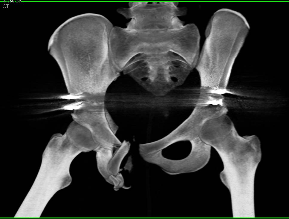 Pelvic Fractures with Open Reduction Internal Fixation (ORIF) - CTisus CT Scan