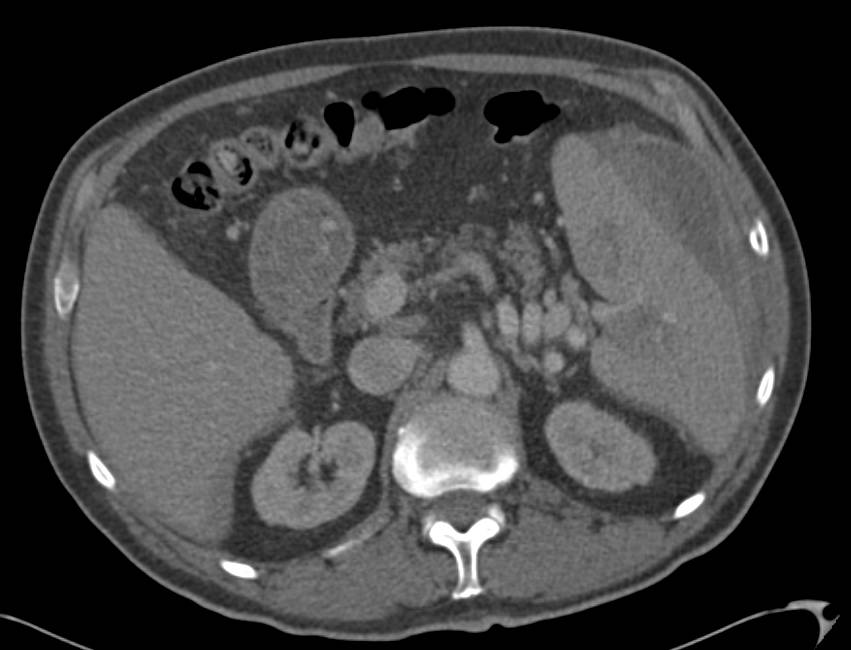 Splenic Laceration with Perisplenic Bleed - CTisus CT Scan