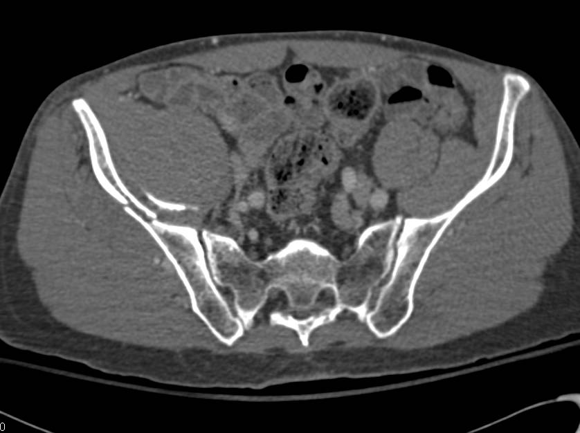Complex Right Acetabular Fracture Involves the Iliac Wing - CTisus CT Scan