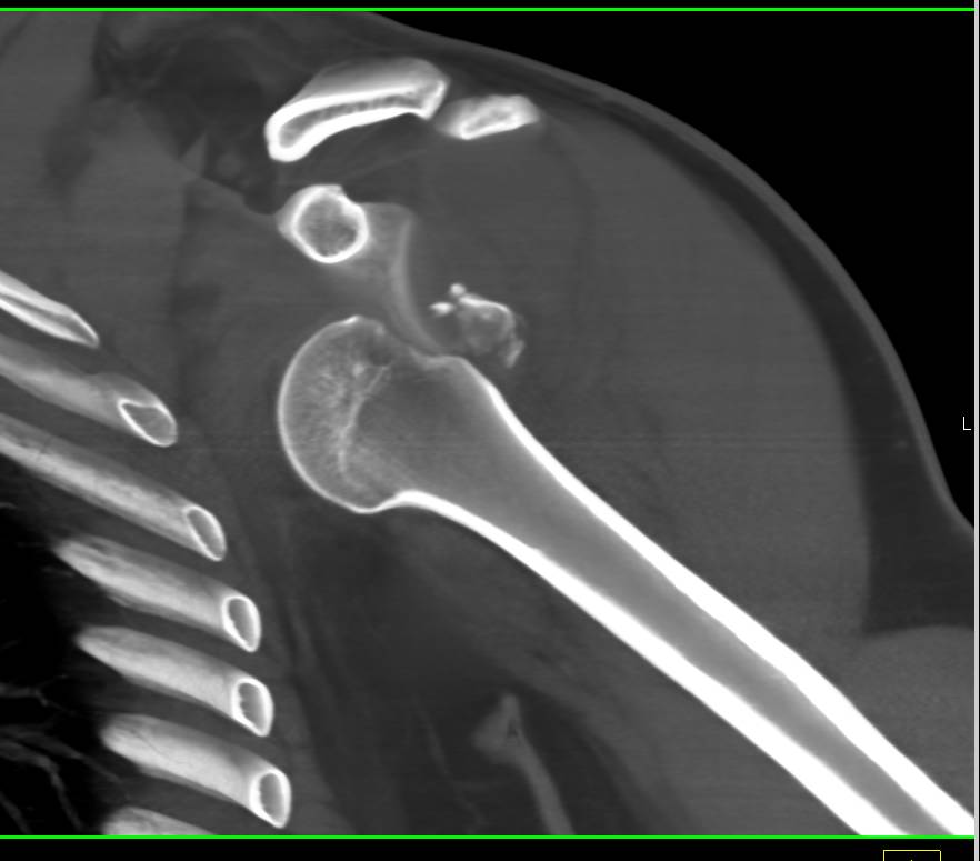 Fracture Dislocation of the Left Shoulder - CTisus CT Scan