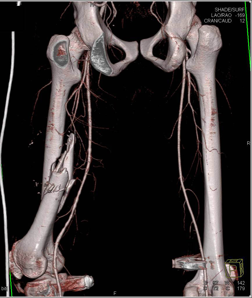 Femur Fracture without Vascular Injury - CTisus CT Scan