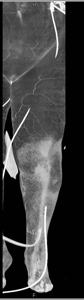 Trauma with Active Bleed Left Calf - CTisus CT Scan