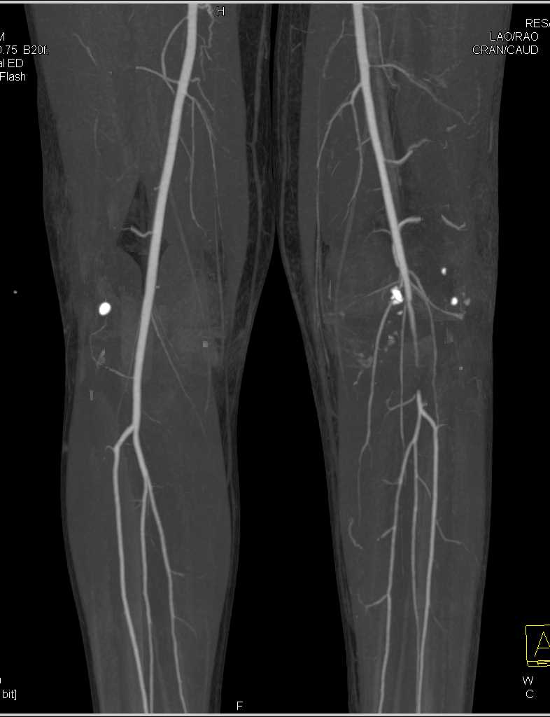 Occlusion of the Left Popliteal Artery - CTisus CT Scan