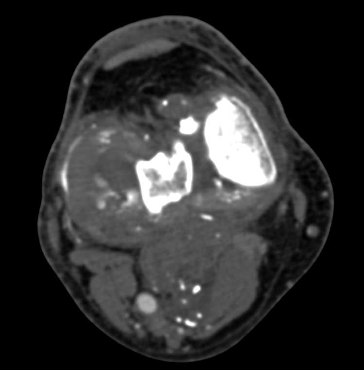 GSW to Knee with Intact Popliteal Artery - CTisus CT Scan