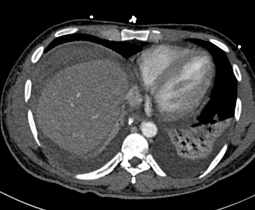 Liver Laceration and Hemoperitoneum - CTisus CT Scan