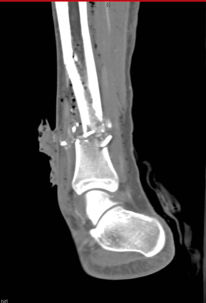 GSW With Comminuted Tibia/Fibula Fractures with Soft Tissue and Vascular Injury - CTisus CT Scan