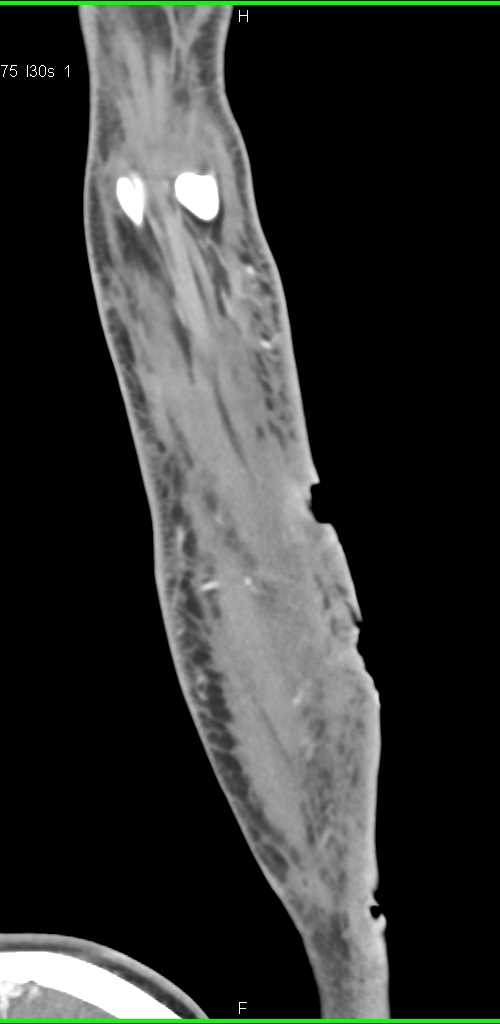 Dog Bite with Ulceration of the Skin and Inflammation - CTisus CT Scan