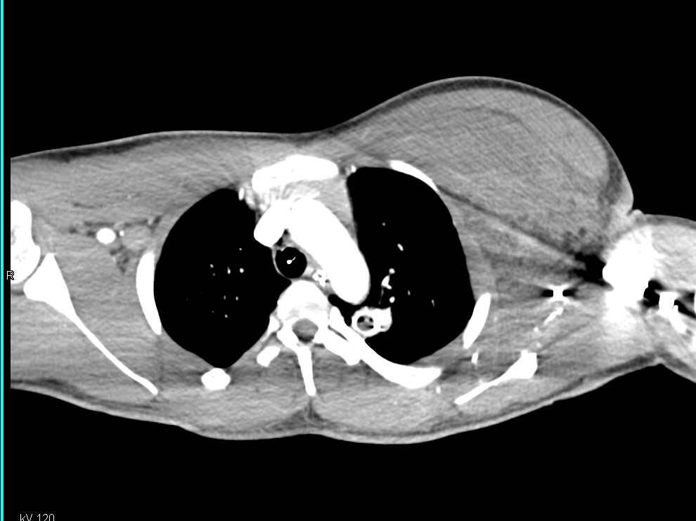 GSW with Pectoralis Minor Bleed and Occlusion of the left Superficial Femoral Artery (SFA) on CTA - CTisus CT Scan